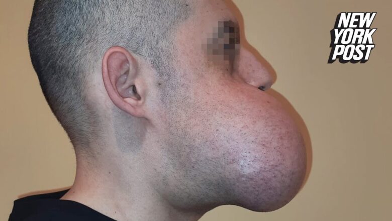 Surgeons reconstruct man’s face with leg bone after 3-pound tumor removal