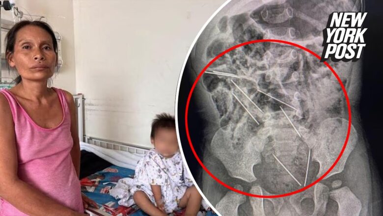 2-year-old accidentally swallows 8 needles: ‘I was focused on my work’