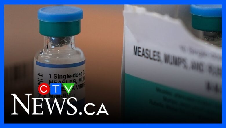 Summer camps takes precautions against measles