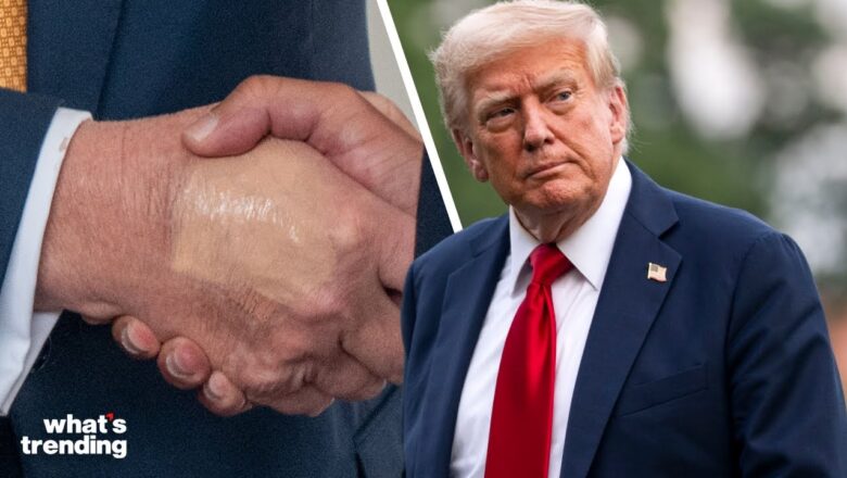 President Trump’s ‘Benign and Common’ Vein Condition Explained